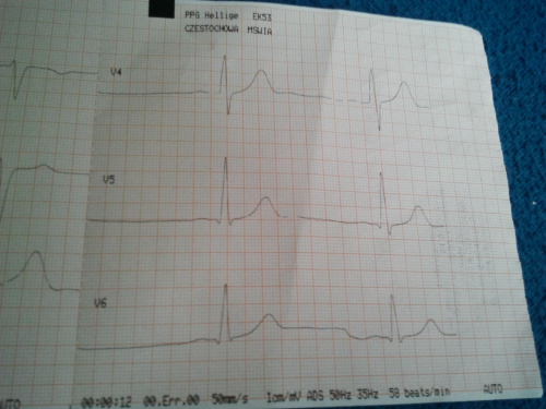 ekg